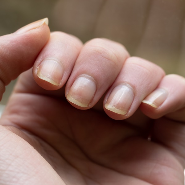 Unhas amareladas veja como tratar
