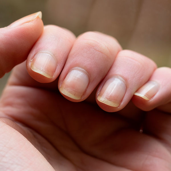 Mão com unhas amareladas